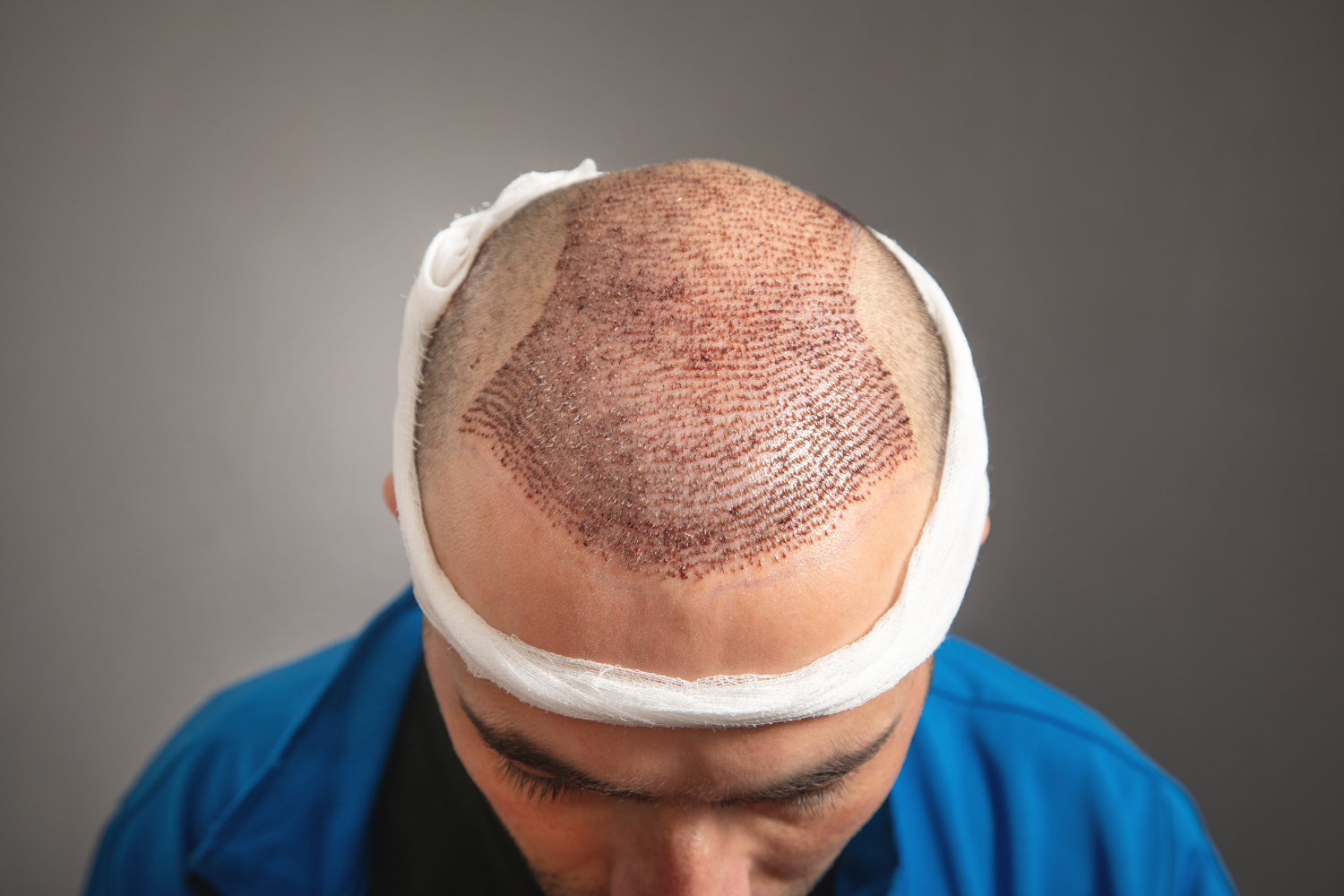 DFI Hair Transplant –